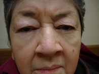 Ptosis Treatment | Droopy Eyelid Treatment | Bronx NY | New York City (NYC)