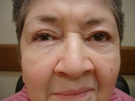 Ptosis Treatment | Droopy Eyelid Treatment | Bronx NY | New York City (NYC)