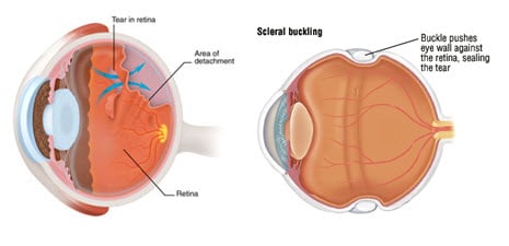 Scleral Buckle Procedure