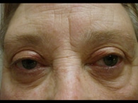 Blepharoplasty | Eyelid Lift | Bronx NY | New York City (NYC)