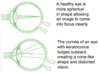 Keratoconus diagram 