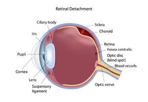 Retinal Tears & Detachments